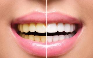 Zoom Teeth Whitening